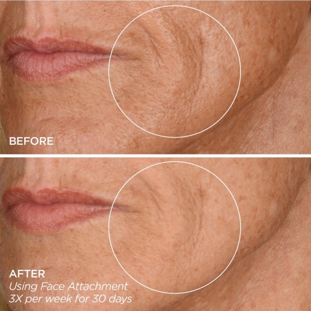 GloPRO Facial Microneedling Tool in LIMITED EDITION PINK STRIPE, New In Case - Picture 7 of 7